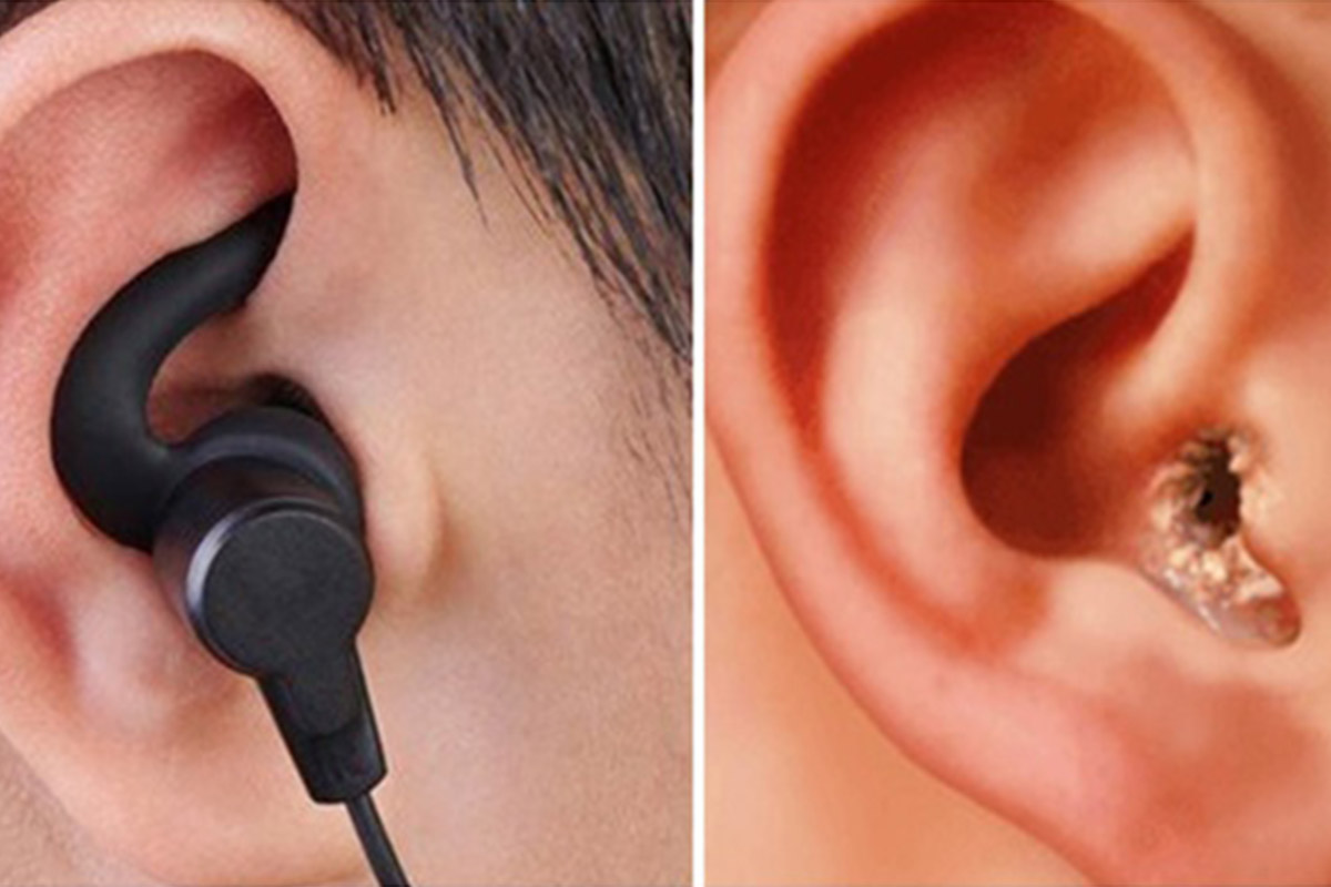 tác hại của việc đeo tai nghe nhiều là tích tụ ráy tai